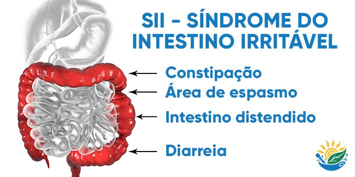 SII intestino irritavel diagnostico e causas